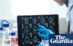 Slow Alzheimer’s diagnoses ‘mean UK patients missing out on experimental treatments’ | Alzheimer's
