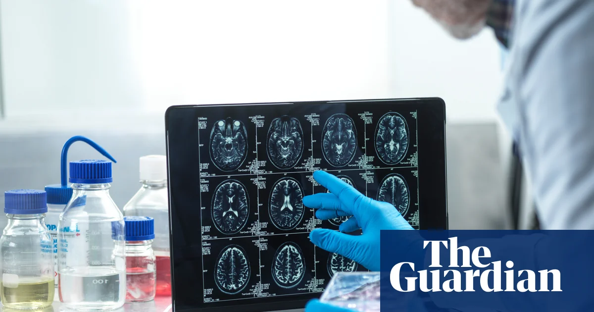 Slow Alzheimer’s diagnoses ‘mean UK patients missing out on experimental treatments’ | Alzheimer's