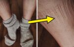 When Sock Indentations Signal Health Problems