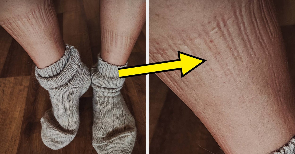 When Sock Indentations Signal Health Problems