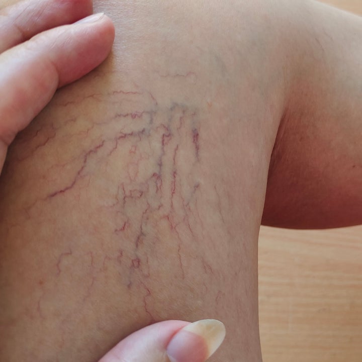 Close-up of a person's leg with visible varicose veins, a hand gently resting on the skin