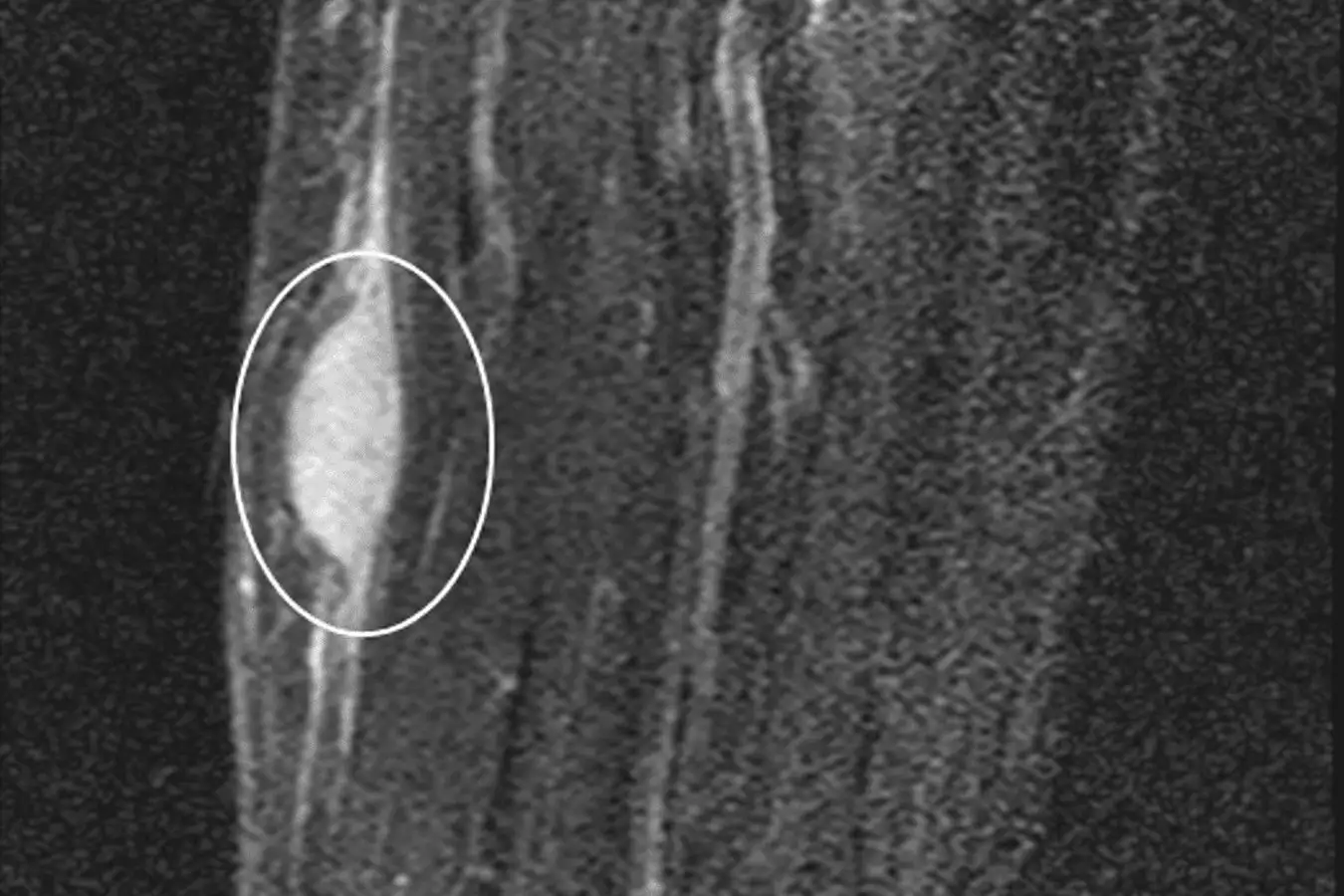 A magnetic resonance imaging scan of the tumour