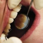 Patients of retired dentist asked to test for bloodborne virus